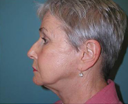 After Facelift Results cosmetic plastic surgery princeton